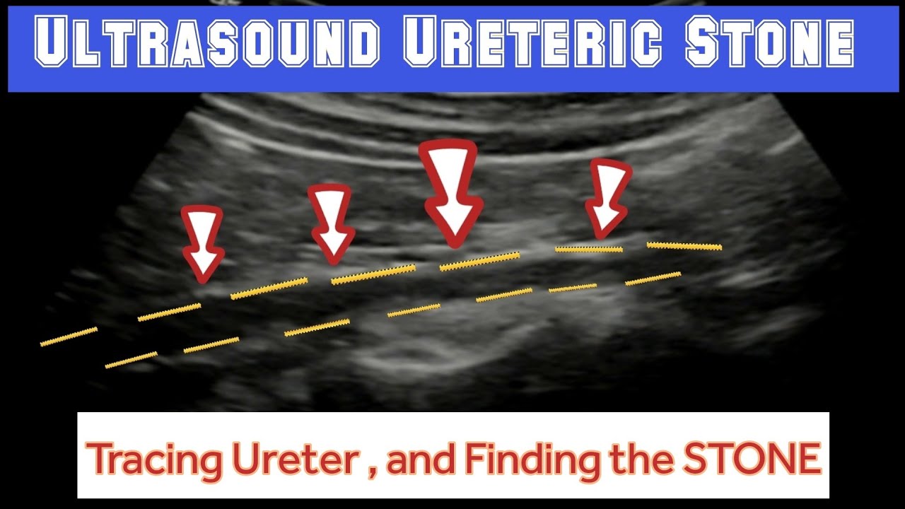 URETERIC CALCULUS || Ultrasound Tracing And Finding URETERIC STONE