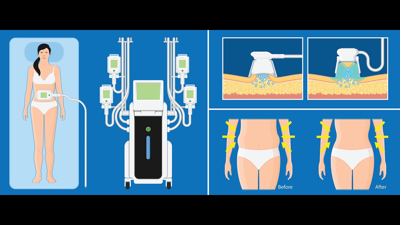 Machine professionnelle de cryolipolyse 2020