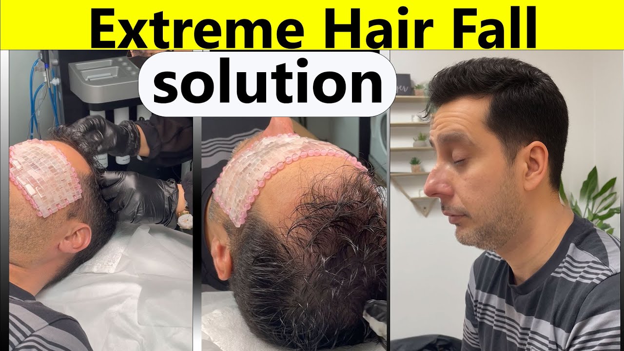 Extreme Hair Fall Treatment | Customized Hair loss Treatment for My Client | Beloria Academy