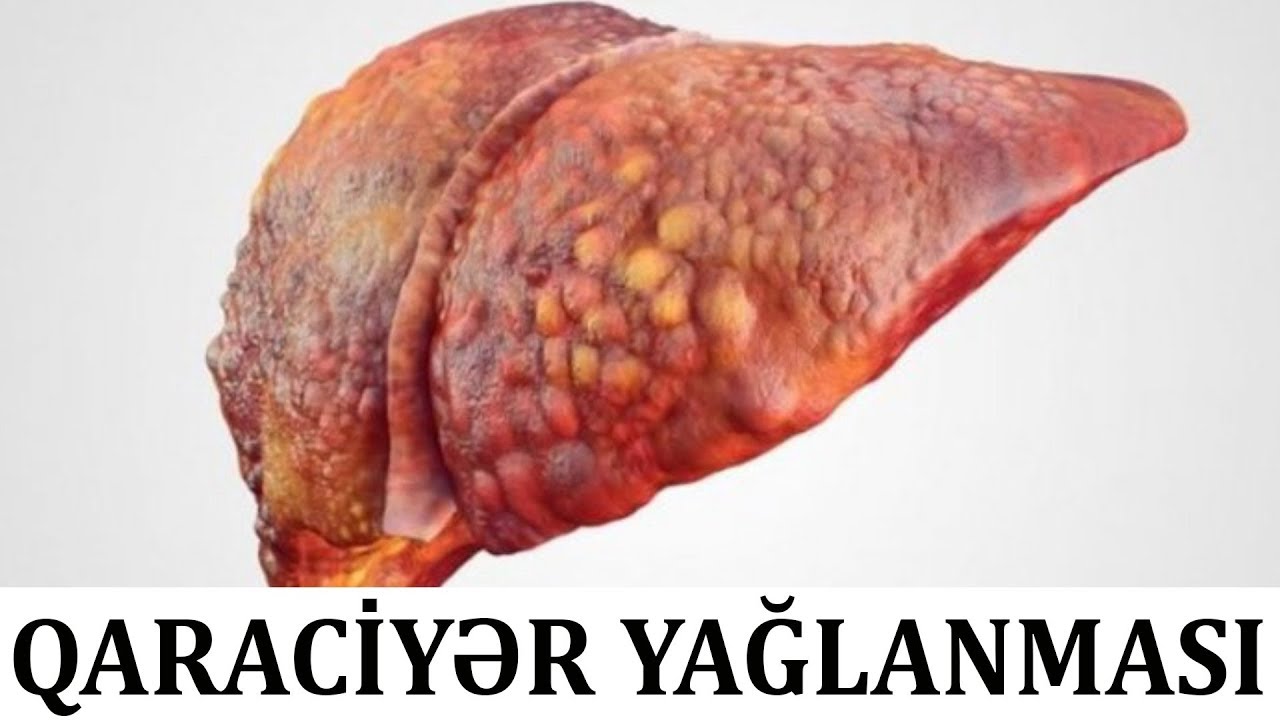 Qaraciyər yağlanması zamanı BUNLARA diqqət edin!