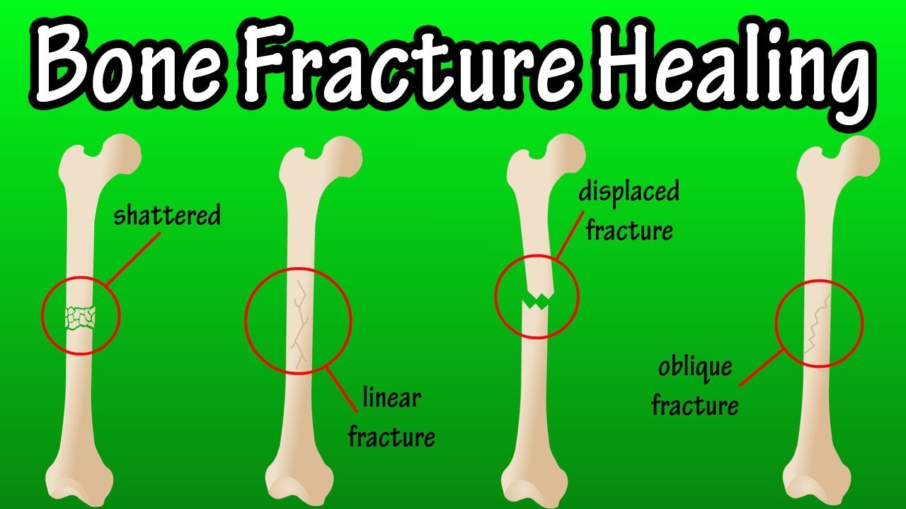 How Does A Bone Break Heal - Bone Fracture Healing Process