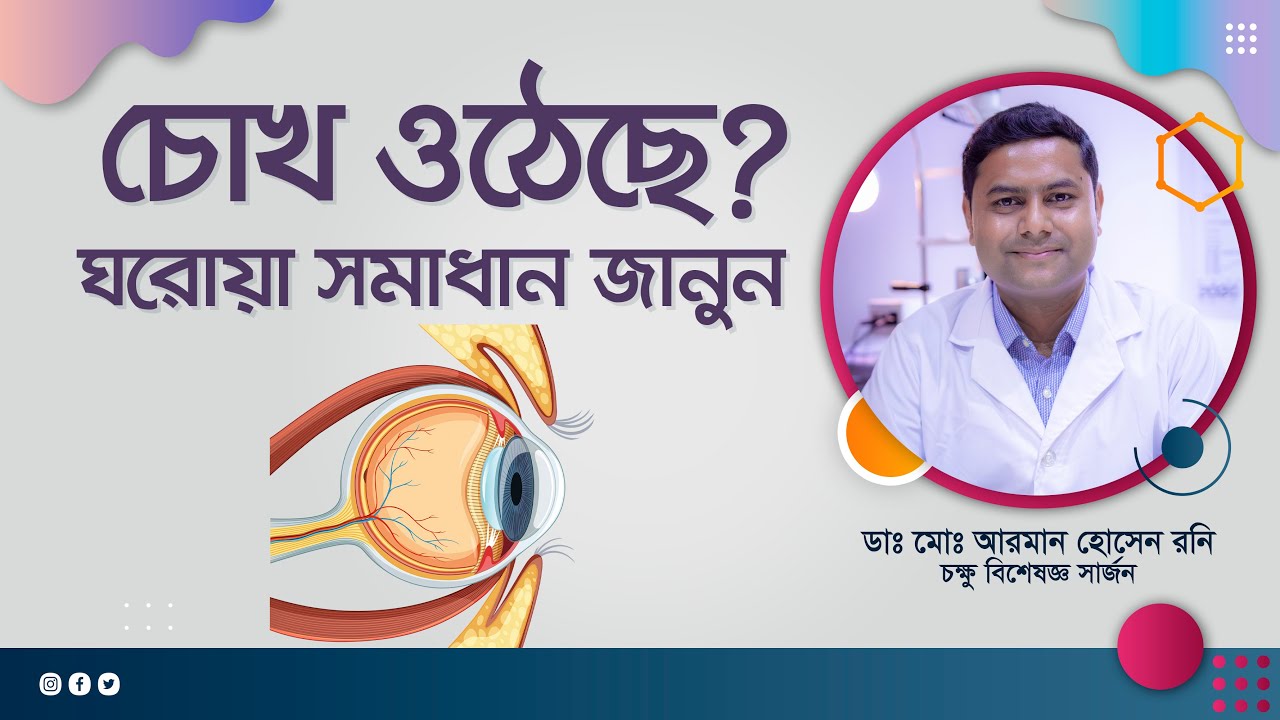 চোখ ওঠা রোগের কারণ ও প্রতিকার। চোখ ওঠার লক্ষণ, ঘরোয়া চিকিৎসায় যেভাবে মুক্তি মেলে।