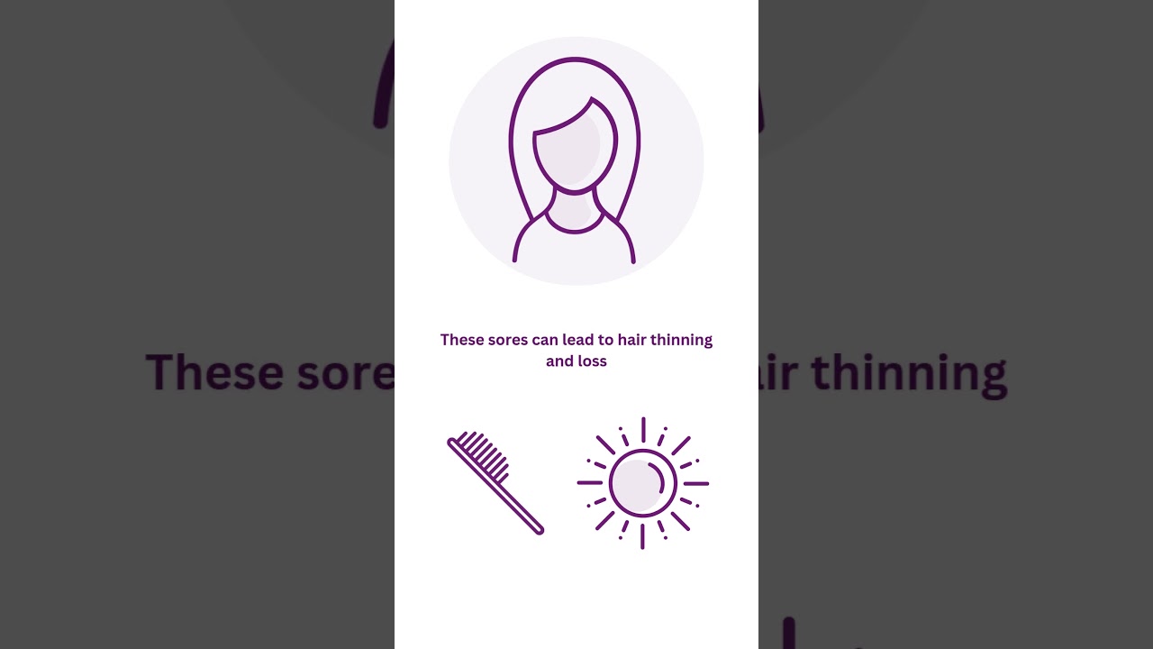 The Four Types of #Lupus