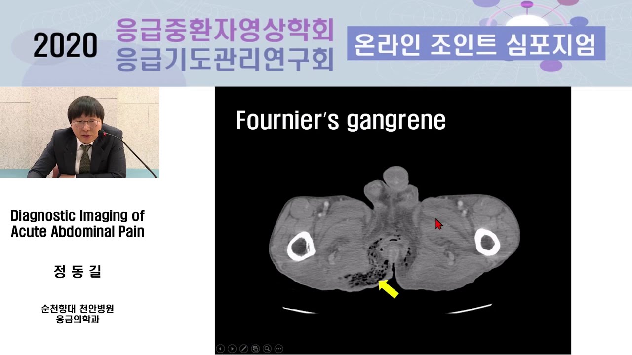 ★★복통 acute abdomen 진단을 위한 복부 CT 순천향대천안병원 응급의학과 정동길 [2020 SECCI 온라인 연수강좌]