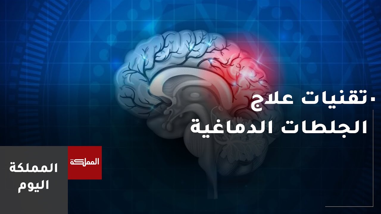 مفهوم الأشعة التداخلية وعلاقتها بالجلطات الدماغية