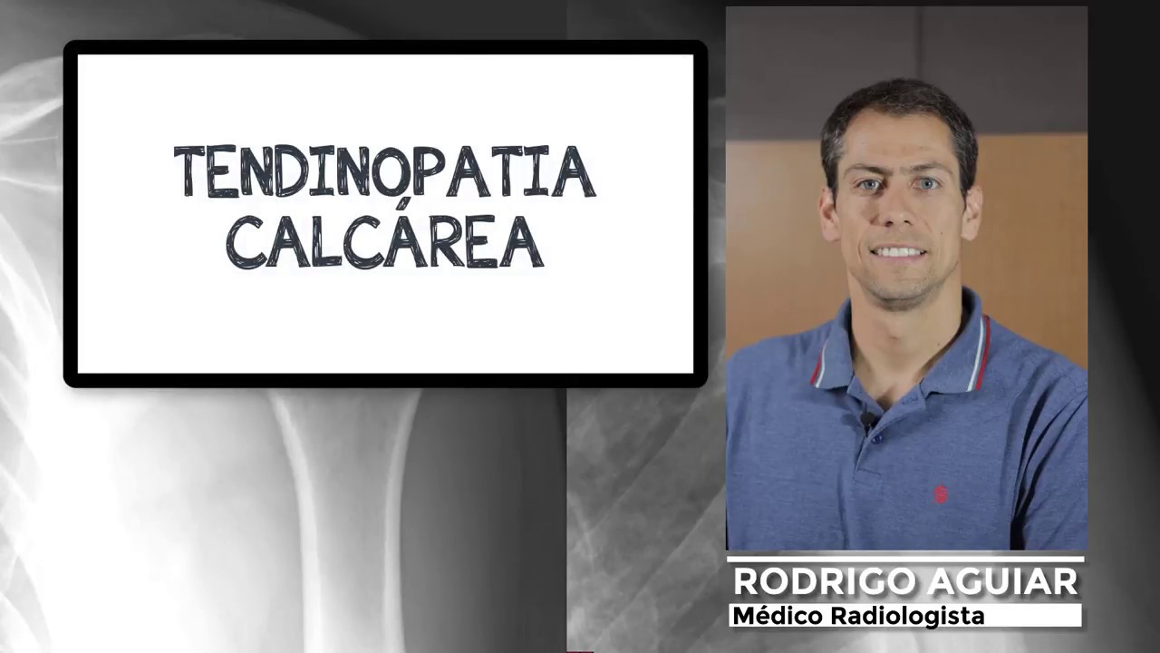 Tendinopatia Calcária do Ombro