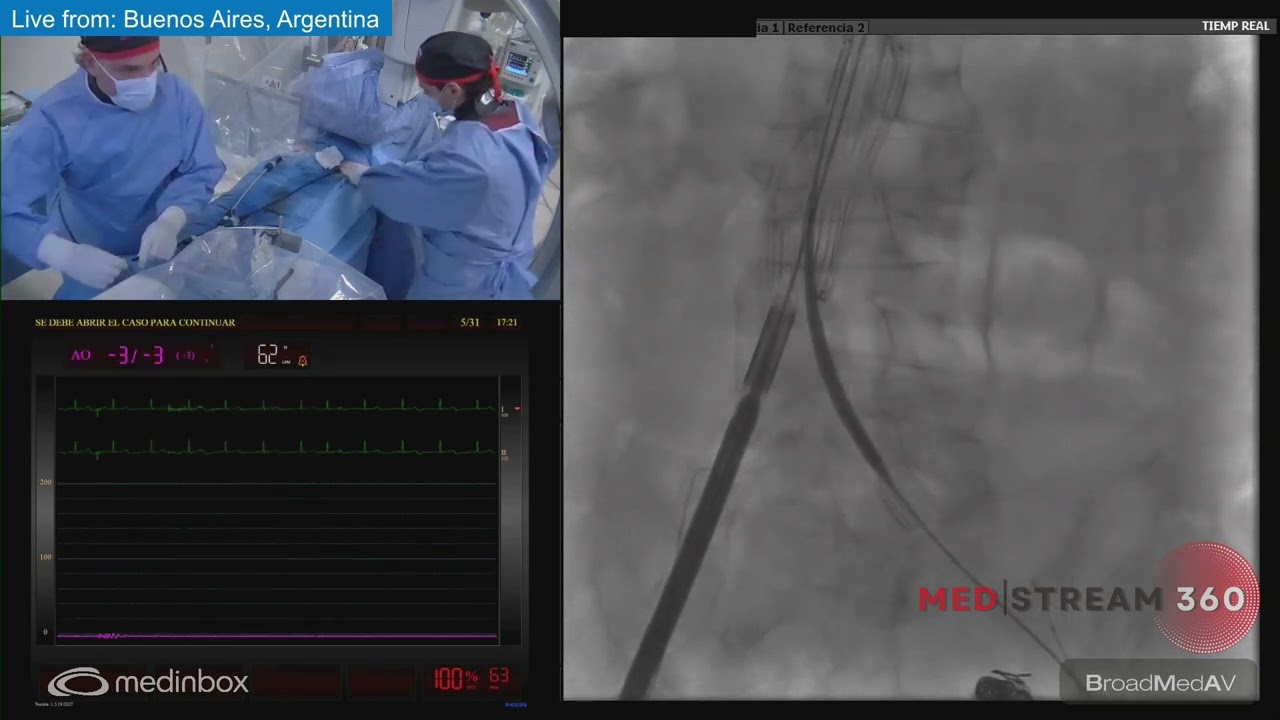 EVAR + Left Hypogastric Artery Embolization
