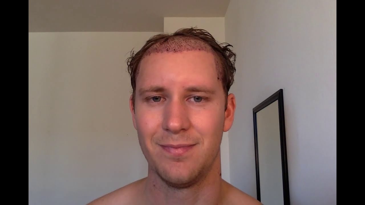 Second Procedure: Day 2 Post-Op (11/13/2015)
