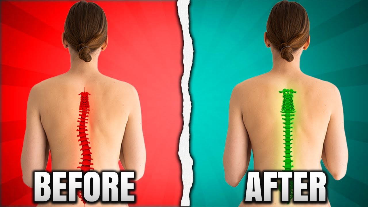 Traditional Scoliosis Treatment Keeps FAILING You | Here's Why