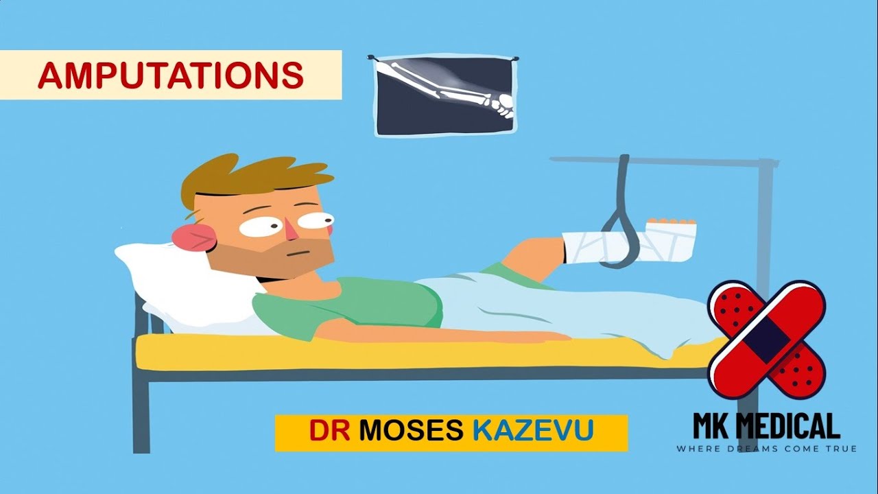 Amputations