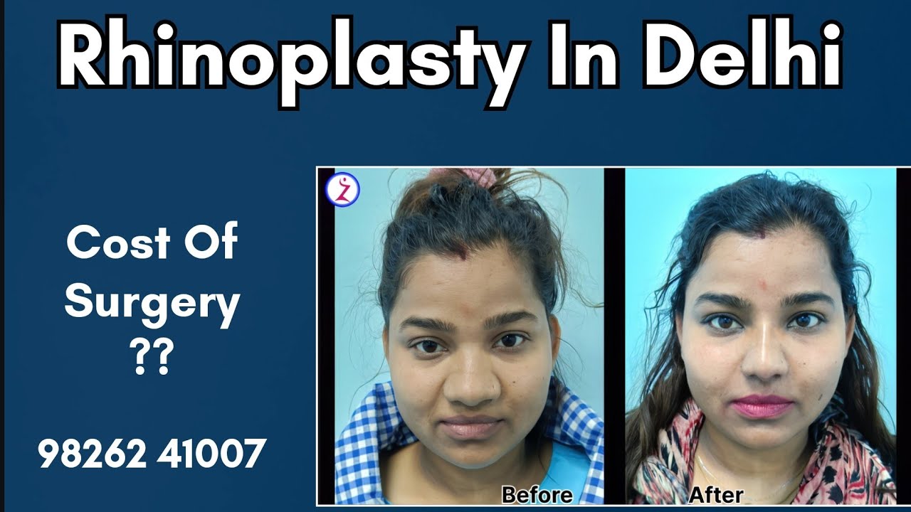 Rhinoplasty In Delhi | Best Rhinoplasty Surgery In Delhi | Zenith Clinic