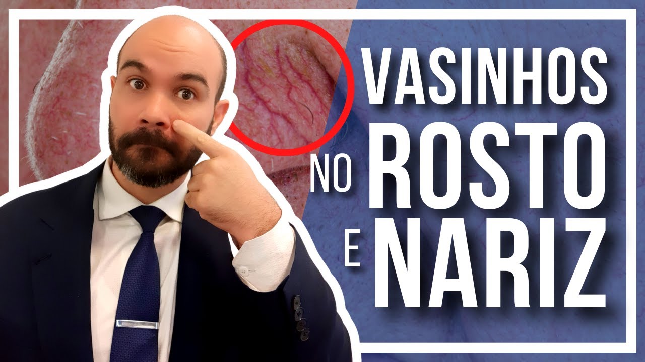 🔴Vasinhos no Rosto e Nariz [Porque surgem e como tratar?]