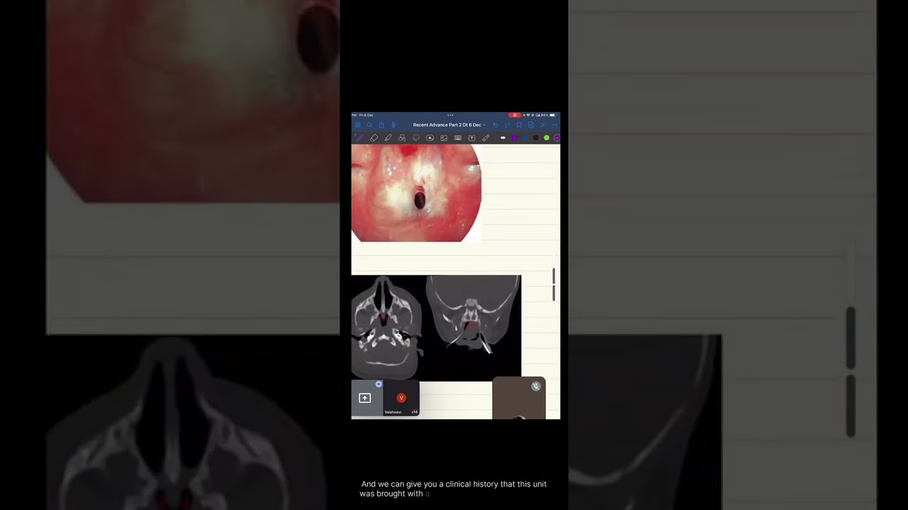 DNB ENT OSCE PRACTICALS EXAM|| 06/12/2024 #ent #dnb