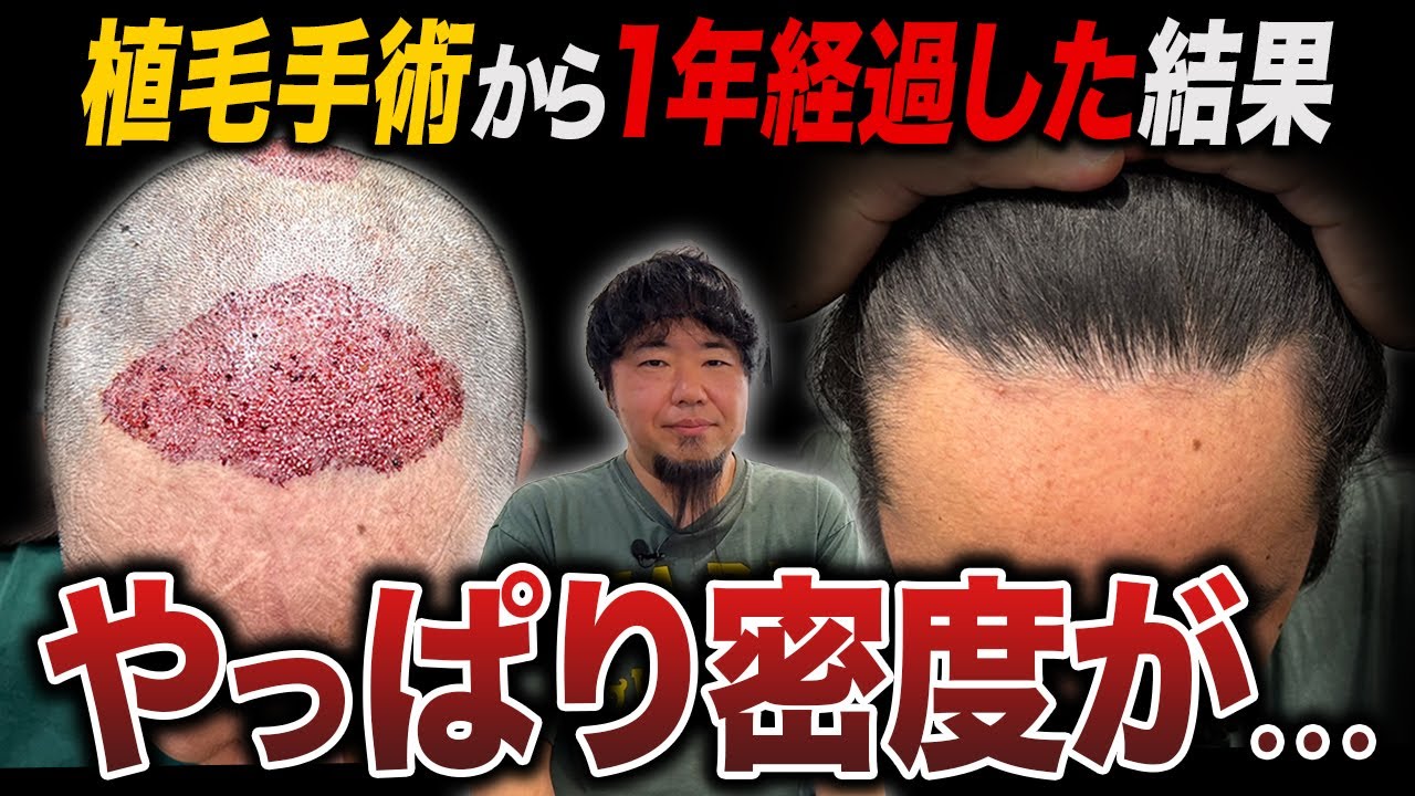 【密度不足!?】40代薄毛が植毛して1年で気になることが発覚...。