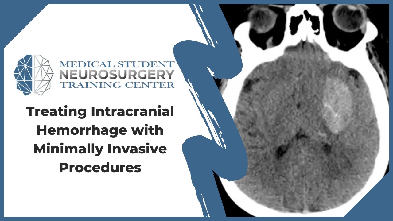 Treating Intracranial Hemorrhage with Minimally Invasive Procedures