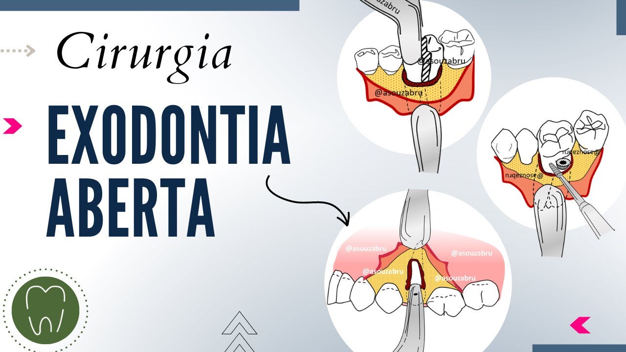 CIRURGIA ABERTA | SOUZA BRU