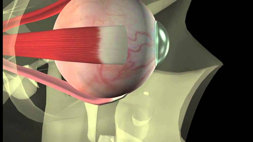 Thyroid eye disease - 12. Squint surgery - The operation