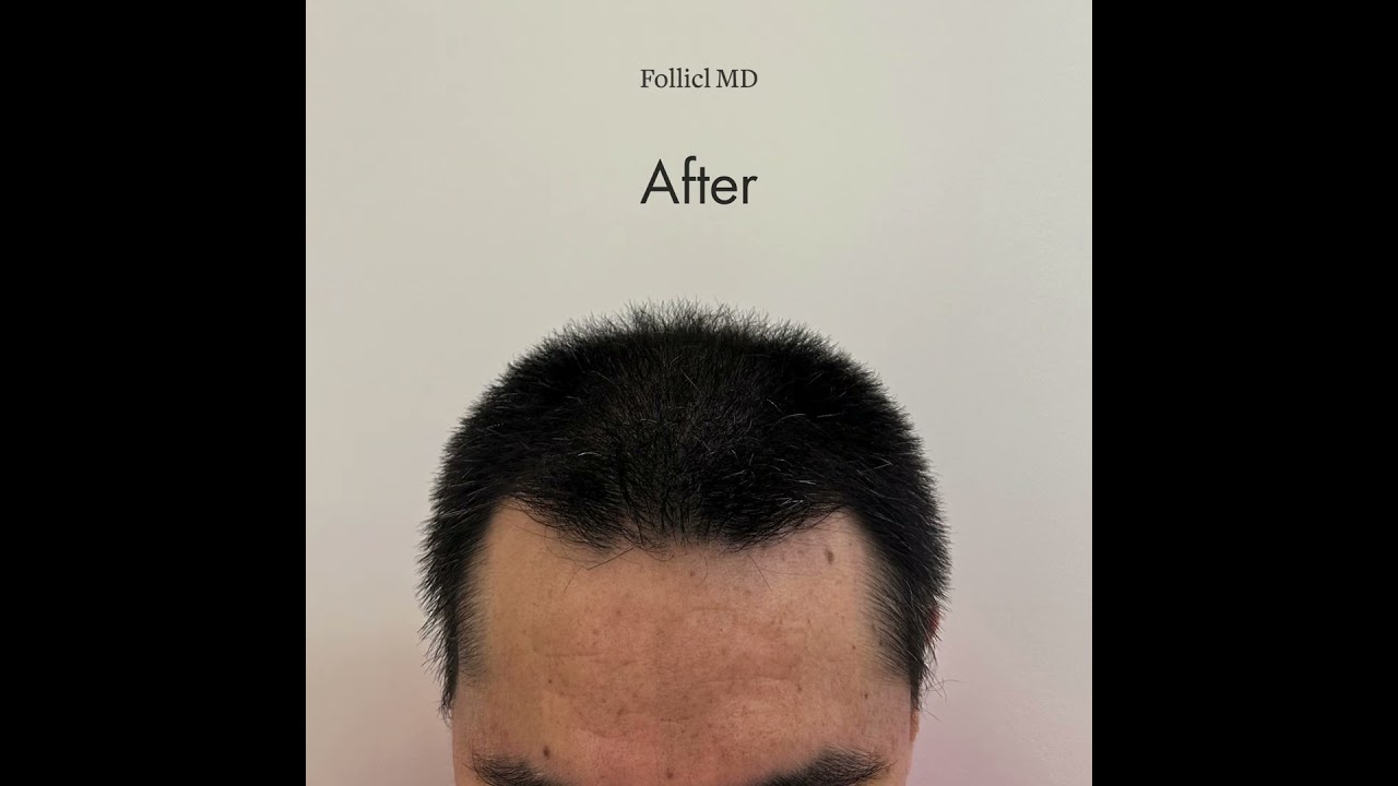 Before & After Hair Transplant for Overall Lack of Density