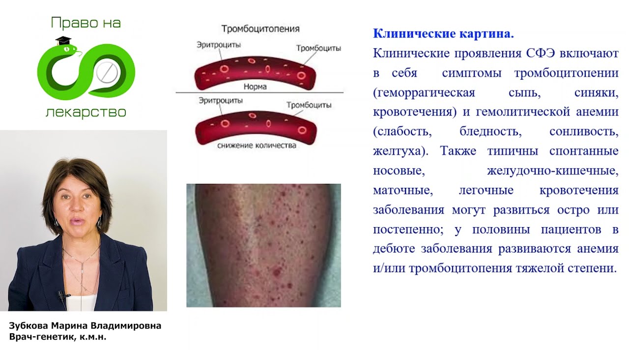 009 ИТП синдром Фишера Эванса