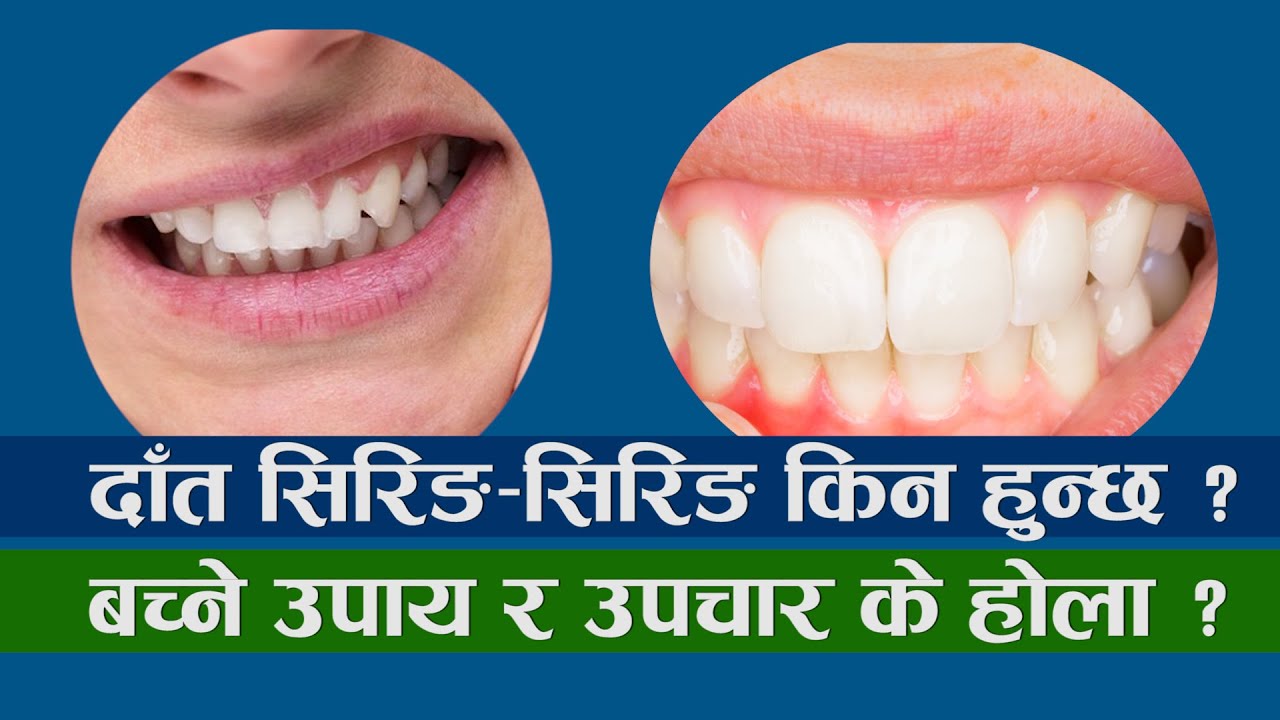 दाँत सिरिङ–सिरिङ किन हुन्छ ?
