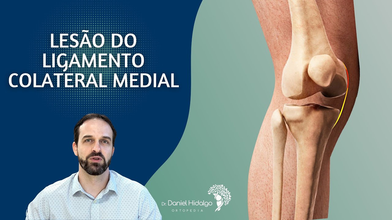 Lesão do Ligamento Colateral Medial ou Tibial - O ligamento da parte interna do joelho