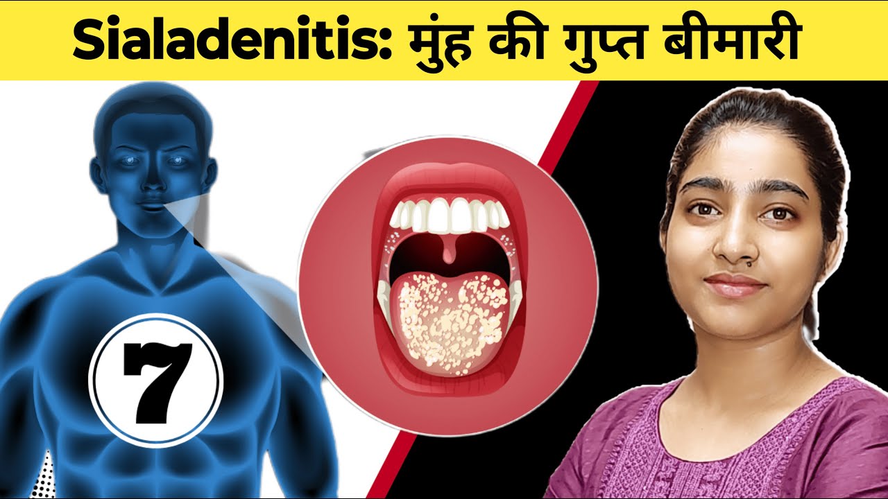 Sialadenitis: Muh Ki Gupt Bimari|Msn|Alka Thakur|