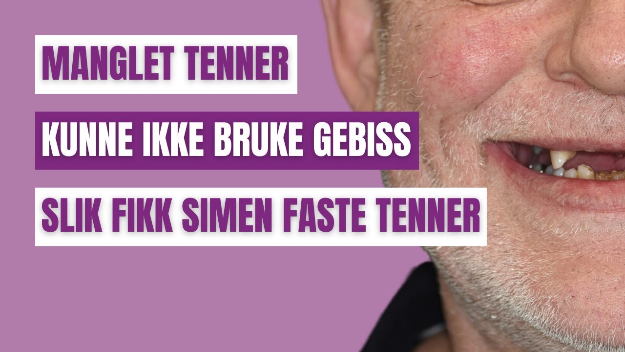 Se den store forandringen når tannlegene hjelper Simen med å få faste tenner