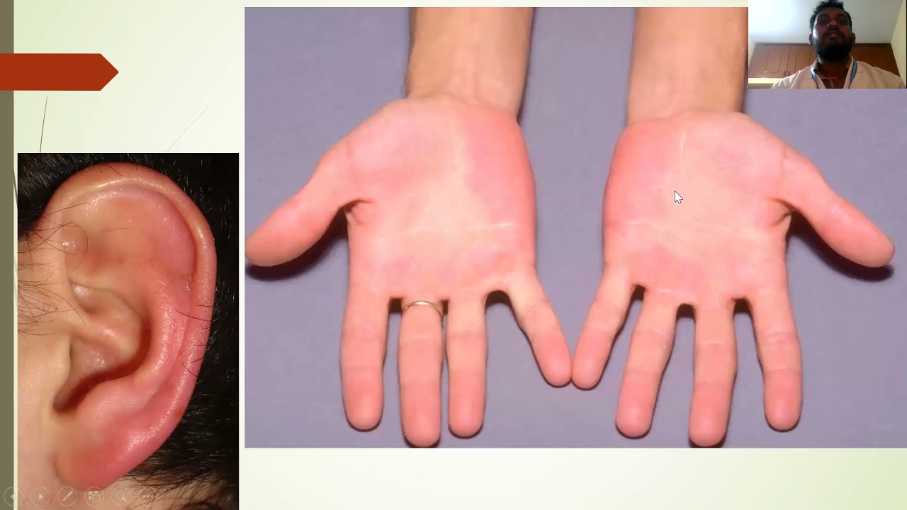 Erythromelalgia - Dr. Chethan
