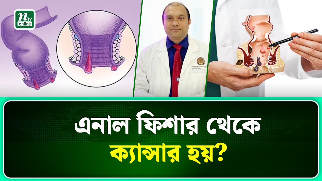এনাল ফিশারকে কোষ্ঠকাঠিন্য ভেবে ভুল করছেন নাতো? | Dr.Md.Nazmul Hoque Masum | NTV News