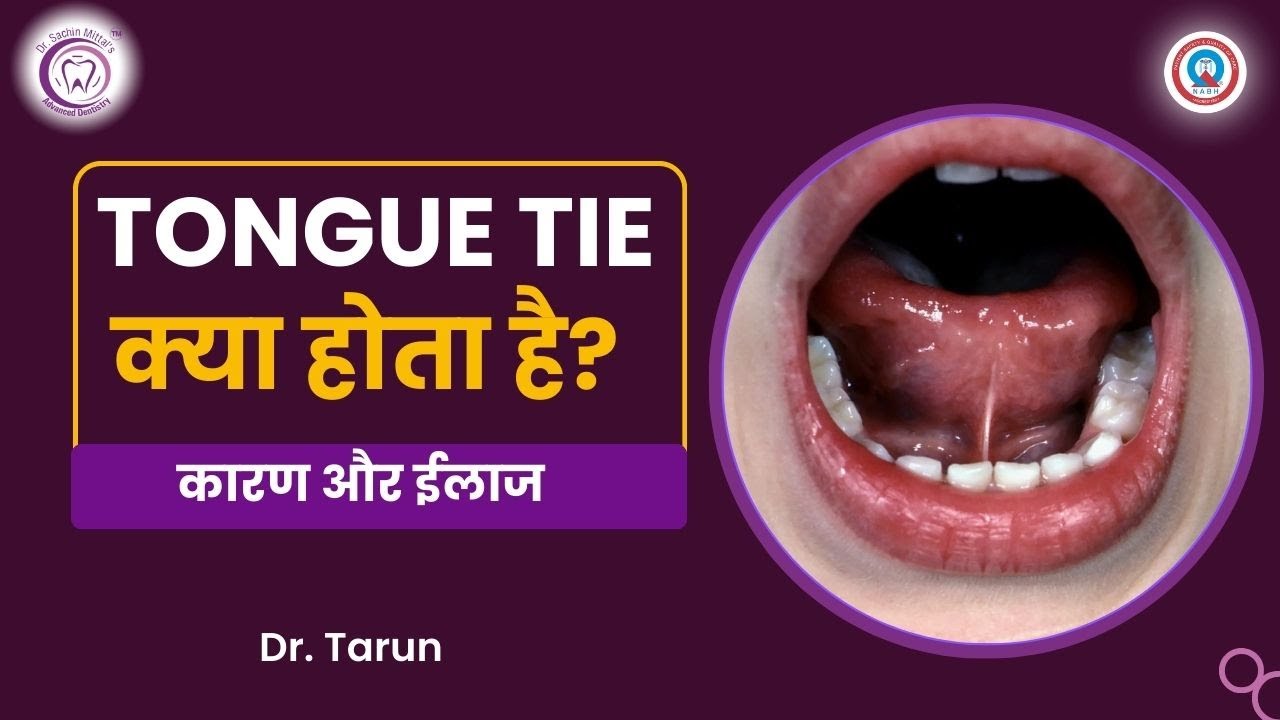 Tongue Tie क्या होता है, कारण और इलाज | Tongue Tie Treatment by Dr. Tarun