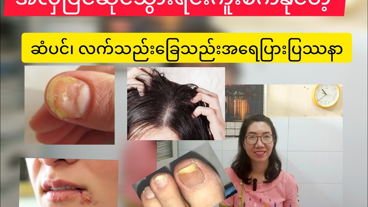 မိတ်ကပ်၊ဆံပင်၊လက်သည်းခြေသည်းတွေ ဆိုင်သွားပြင်လျှင် သတိပြုစရာအရေပြားပြဿနာSkin infection from spas