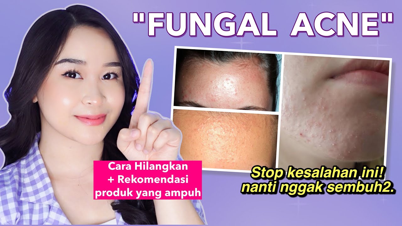 8 Cara Menghilangkan Jerawat Kecil-Kecil di Wajah (