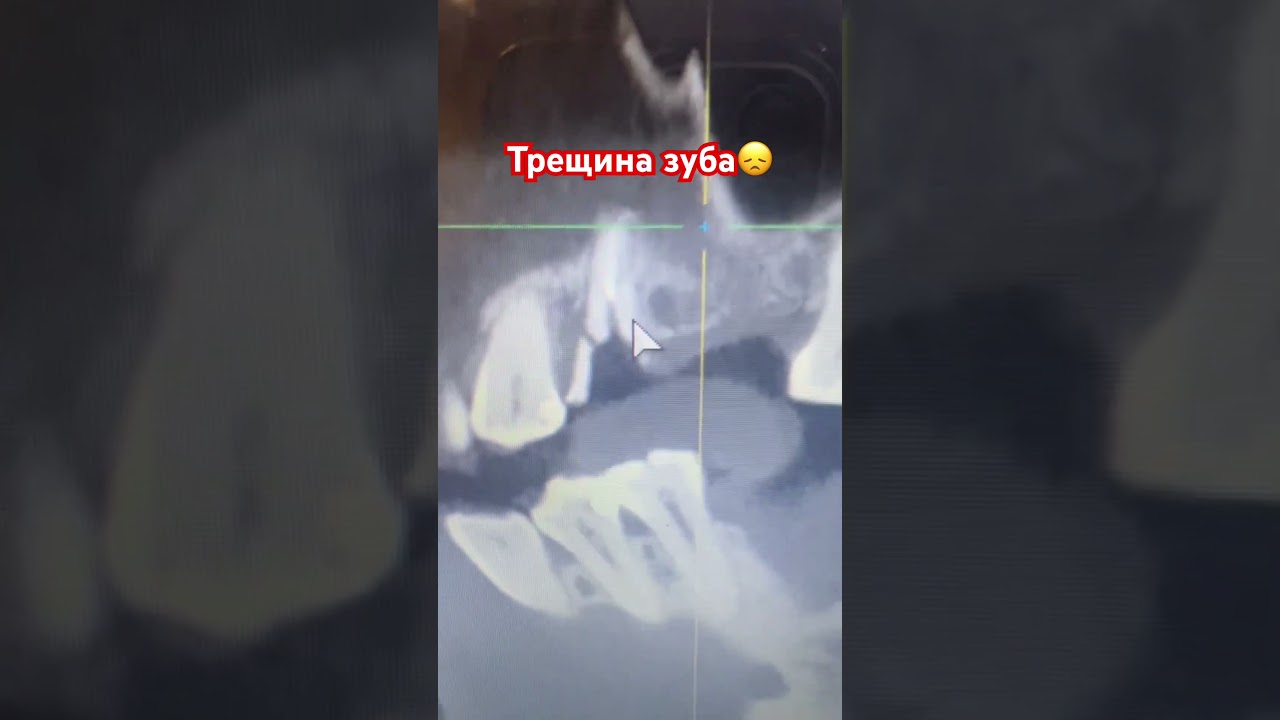 Трещина зуба - удаление🥲