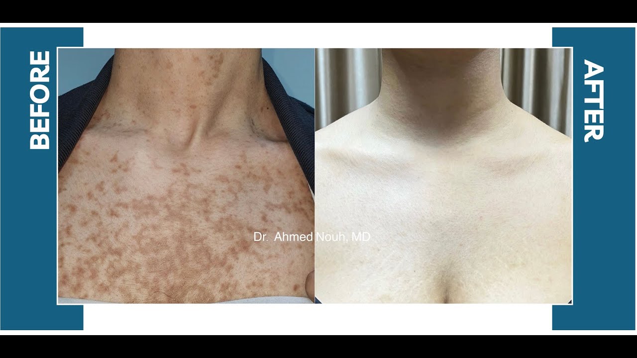 Reticulated truncal pigmentation