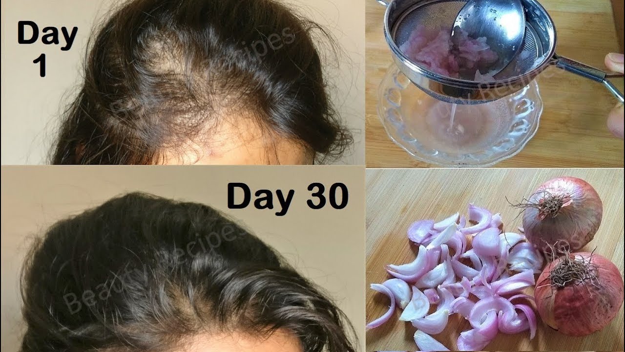 Regrow Lost Hair from Roots with Onion juice & Coconut Hair Oil - Double hair growth & get Long hair