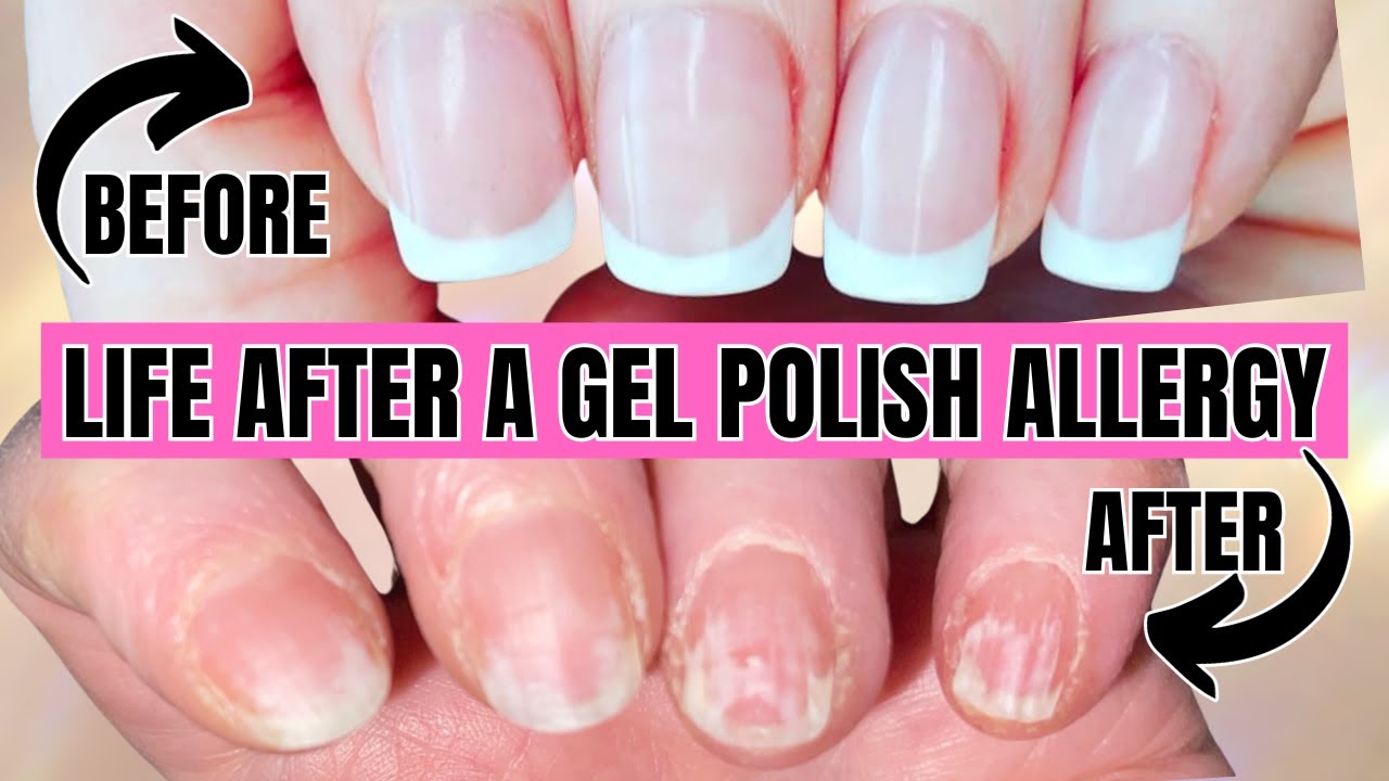 Pt. 1, My Gel Allergy Story, Why it Started & How I'm Doing + How to Avoid Gel Allergies 