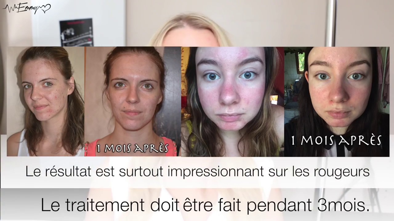 Bloggeuse Emmymakeuppro vous parle de Luminesce sur l'acn&eacute;