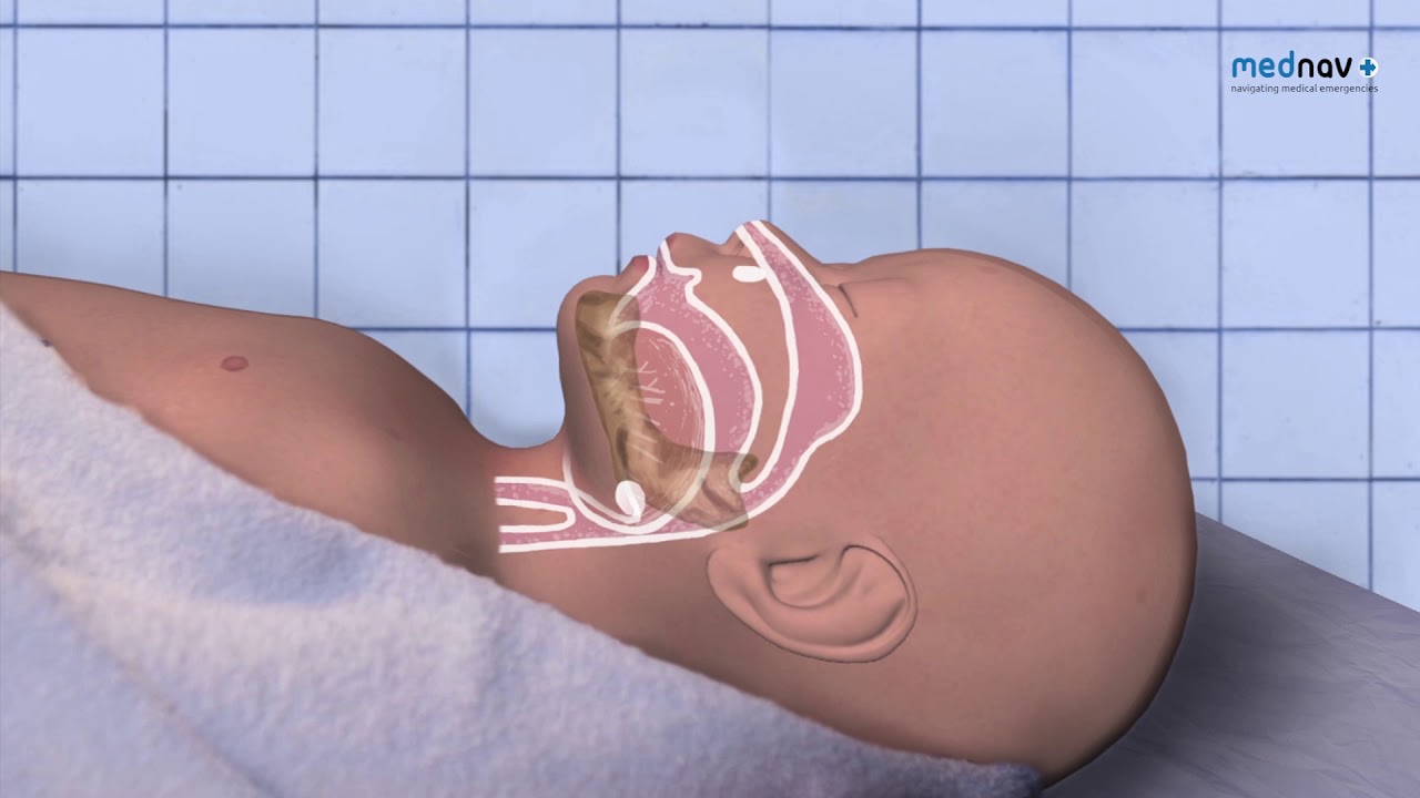 How to perform Neonatal Resuscitation, Resuscitate Newborn, NLS, Newborn Life Support 2015 guidance