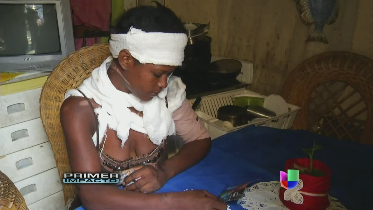 Una joven madre quedó con el rostro desfigurado tras ataque de vecina - Primer Impacto