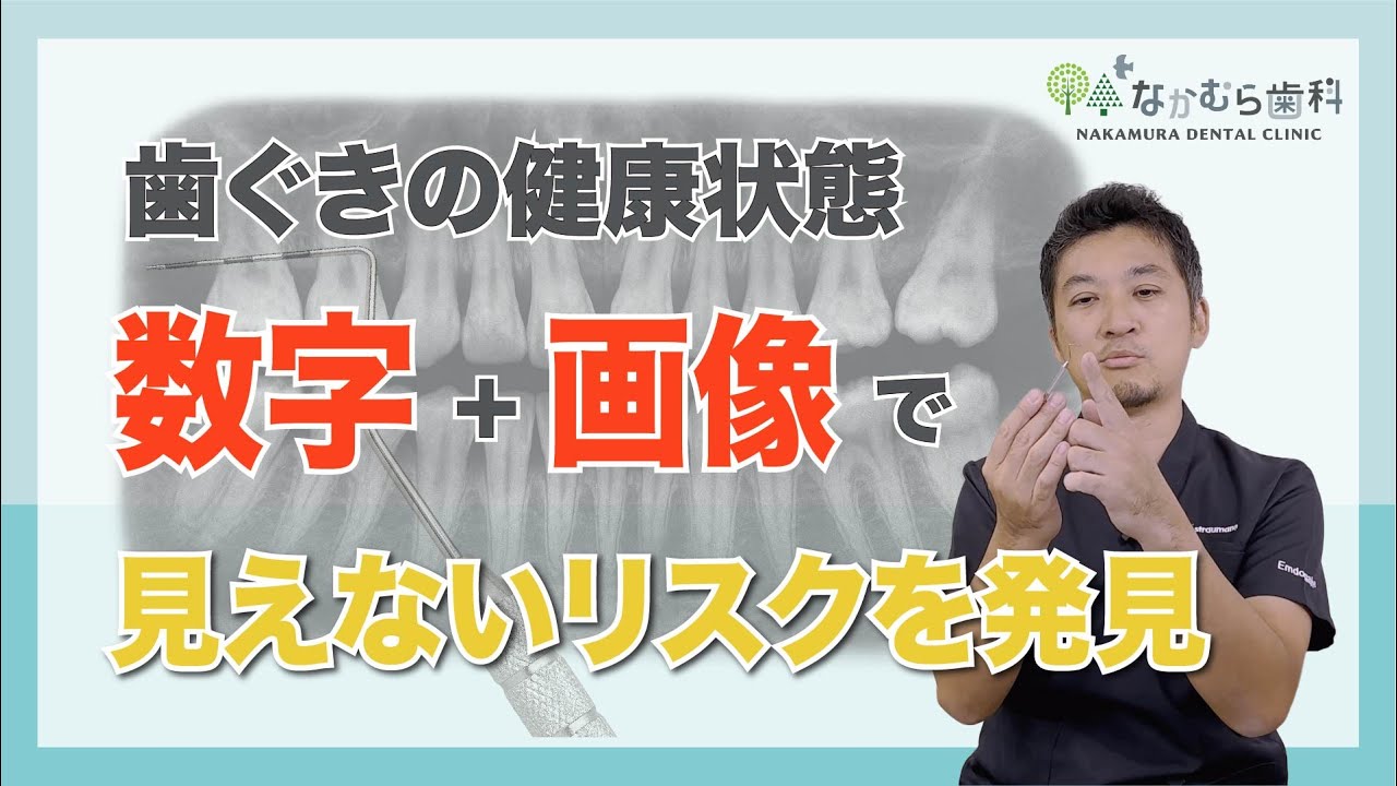 歯周病検査でよく聞こえる数字ってなに？知りたい方は必見！歯周病を発見するための歯ぐきの検査！歯科医が実際の歯周病検査を徹底解説【なかむら歯科（我孫子市）】