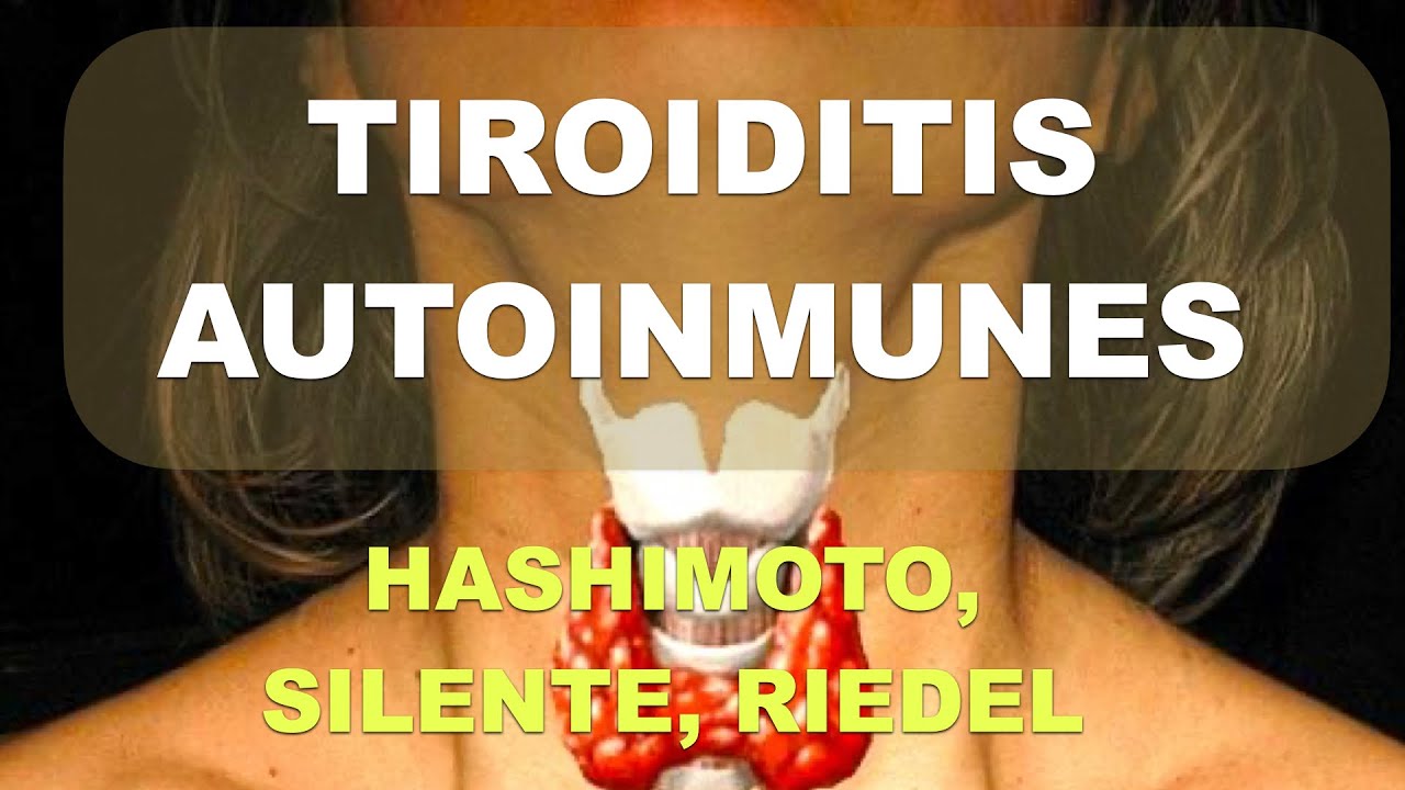 Tiroiditis (parte 2)  Autoinmunes: Graves, Silente, Riedel