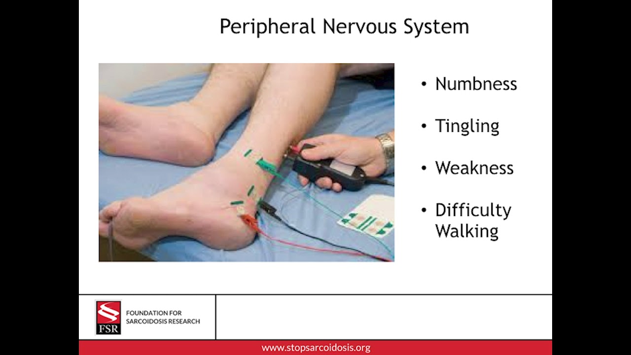 Dr. Brandon Moss - Neurosarcoidosis