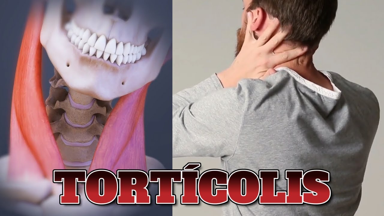 ¿Dolor de cuello constante? Podría ser Tortícolis