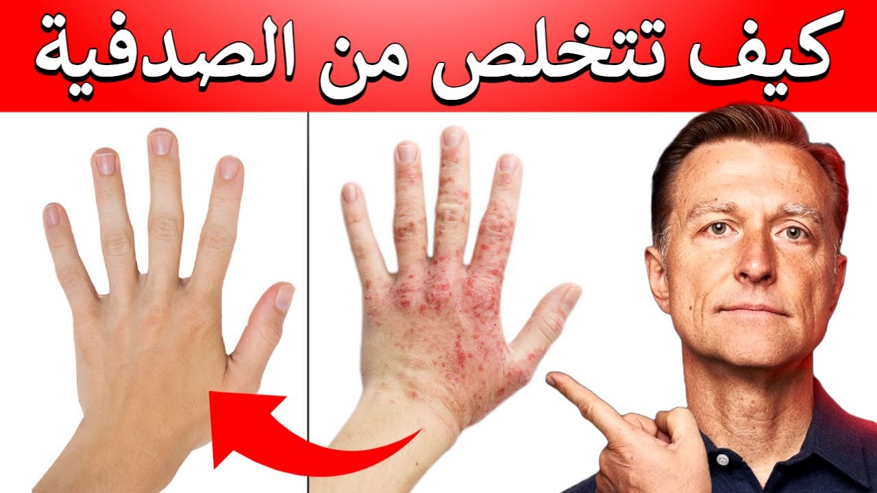 علاج طبيعي وفعال للصدفية ومشاكل الجلد المشابهة
