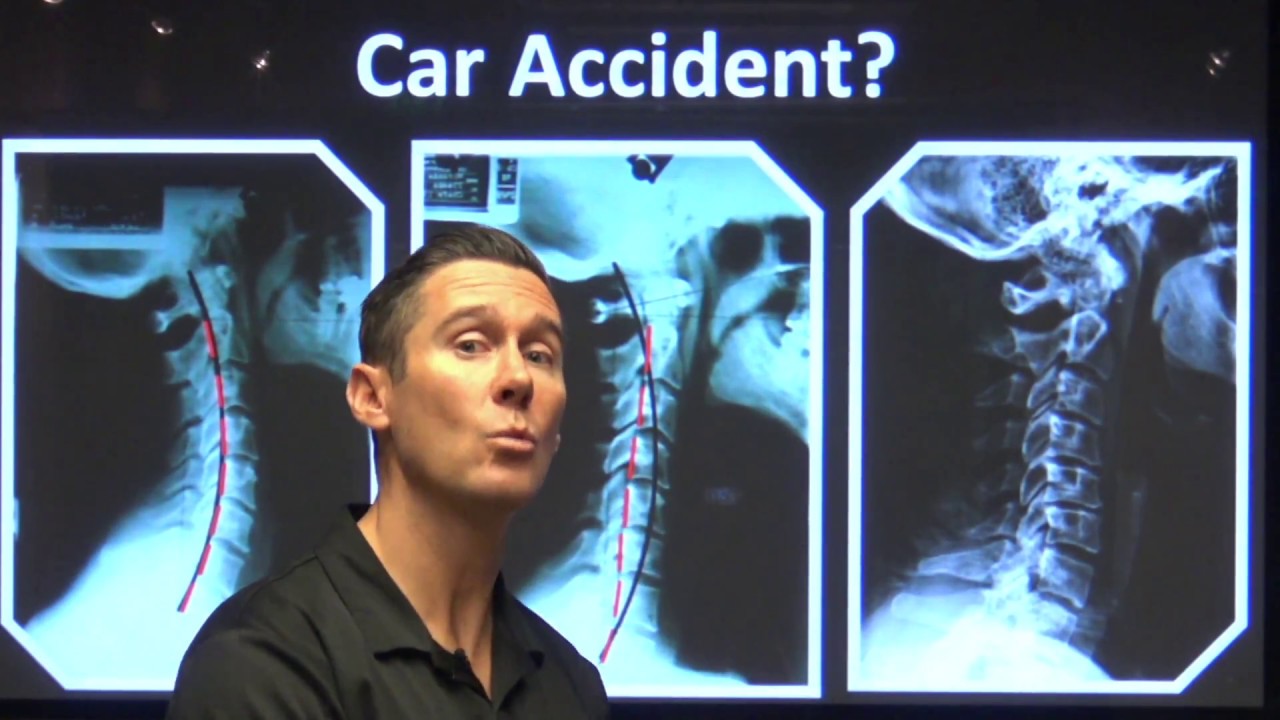 Car Accidents and Whiplash - 5 mph Will Do It