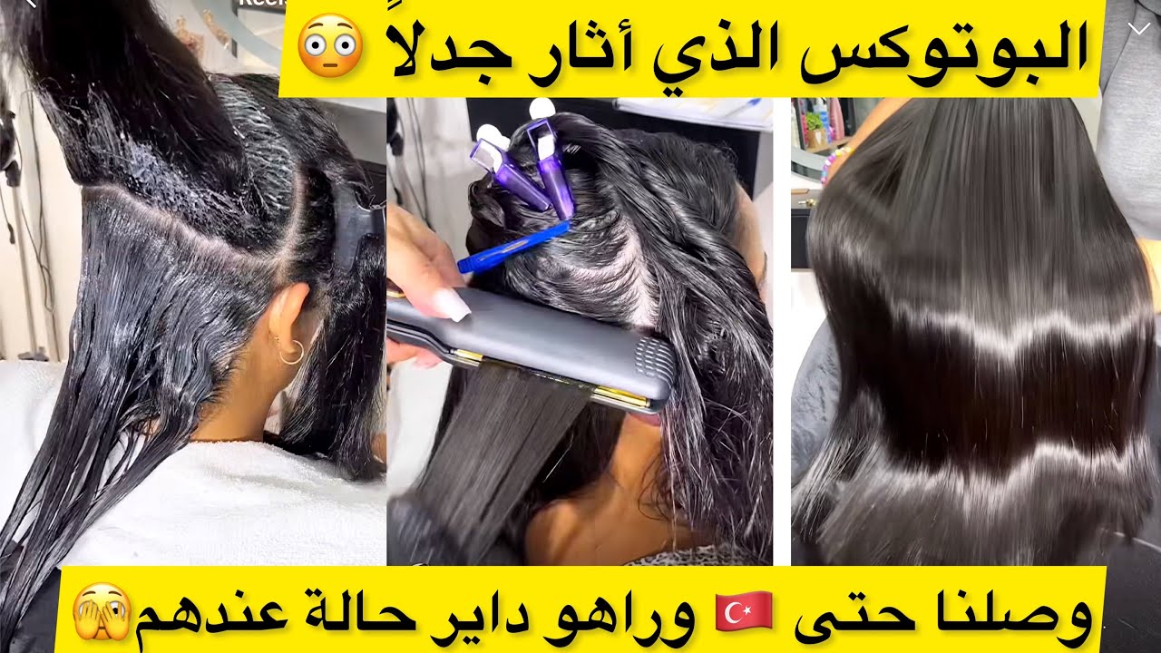 البوتوكس لي دار حالة وصل قريب 2 ملاين مشاهدة🥺الفيديو مبعوت من 🇹🇷 وصلت حتى لعندهم😎شوفوه تفهمو👊🏻