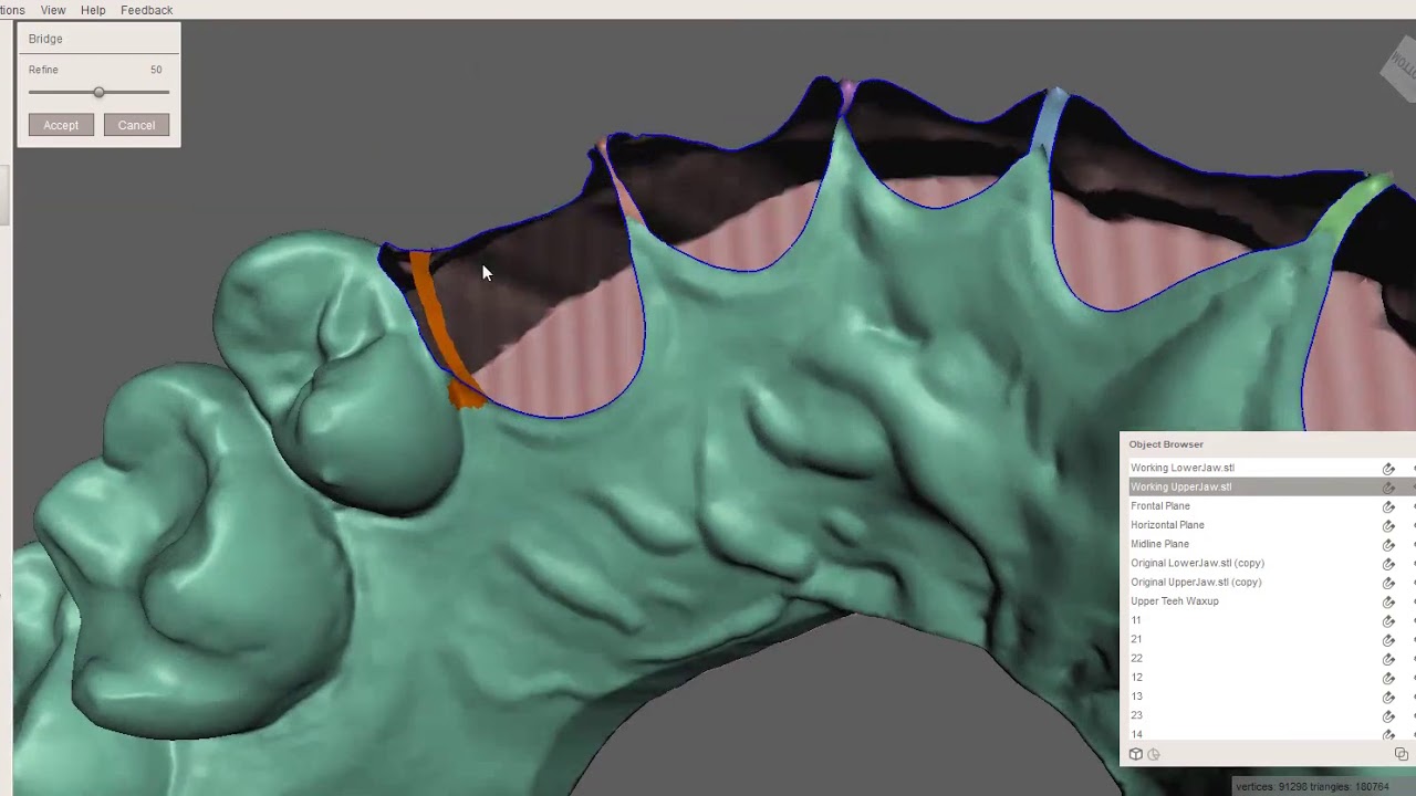Meshmixer Dental Model Editing and Tooth Separation