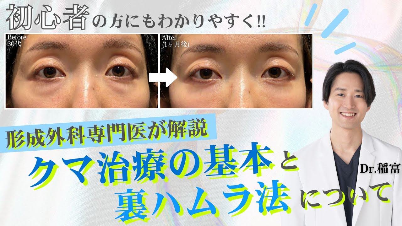 自分に合う施術方法は？クマ取りの基本を医師歴13年の専門医が徹底解説【裏ハムラ】