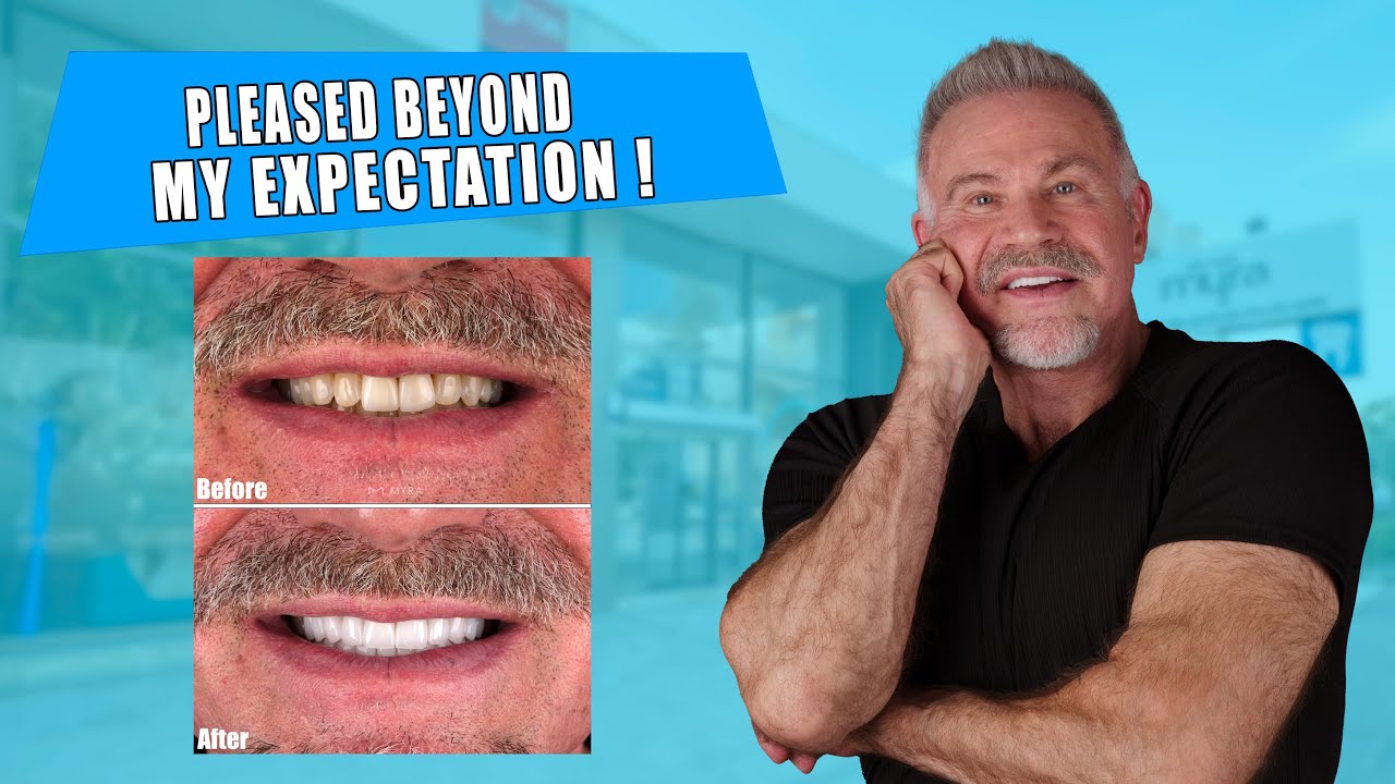 From USA to Turkey: Joe's New Smile with 20 Zirconium Crowns | Dental Tourism in Antalya