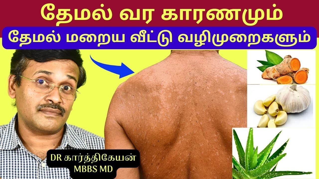 தேமல் மறைய என்ன செய்வது? | White patches on face skin home remedies | treatment for tinea
